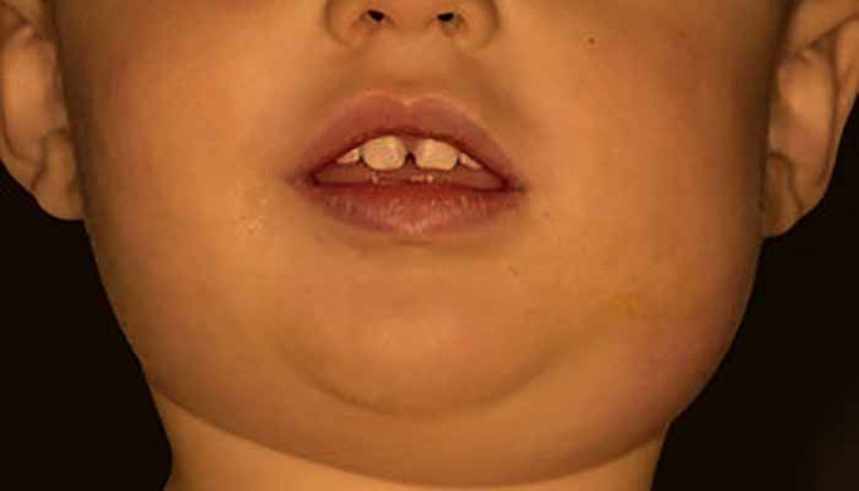 Picture of Mumps